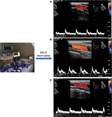 Acute Effect of Enhanced External Counterpulsation on the Carotid Hemodynamic Parameters in Patients With High Cardiovascular Risk Factors